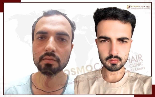 Hair Transplant Clinic In Chandigarh
