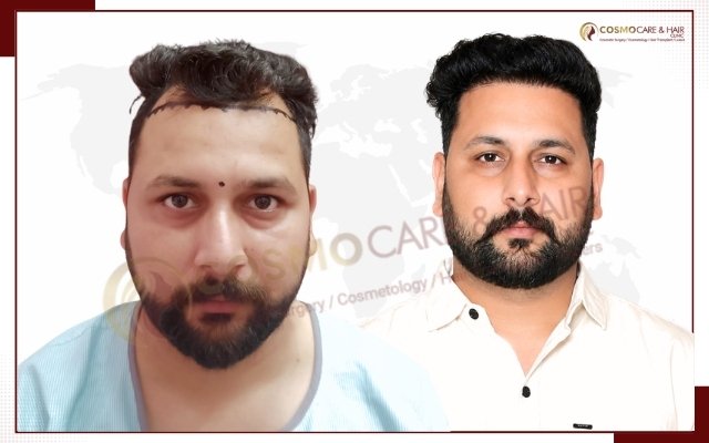 Best Hair Transplant In Chandigarh